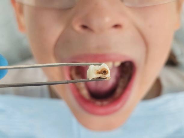 Best Emergency Wisdom Tooth Extraction in Watsontown, PA
